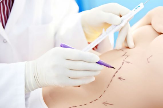 Liposuction