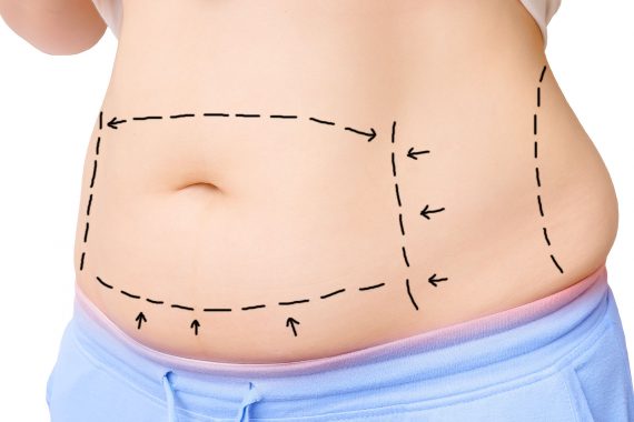 Tummy Tuck