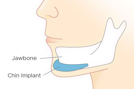 Chin Implants - Chin Augmentation Surgery