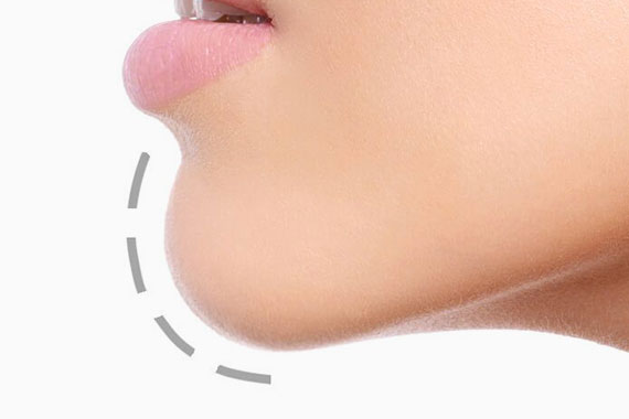 Chin Implants - Chin Augmentation Surgery